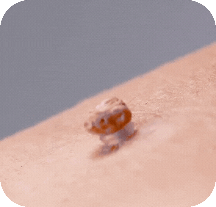 TagClear™ – Schmerzfreie Hautlappenentfernung