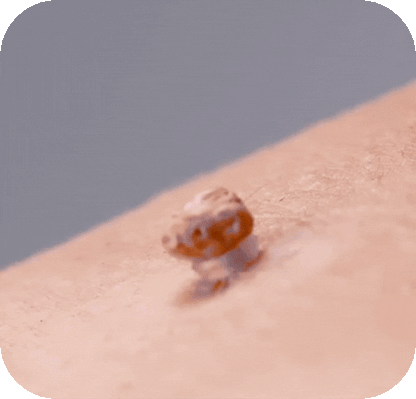 TagClear™ – Schmerzfreie Hautlappenentfernung
